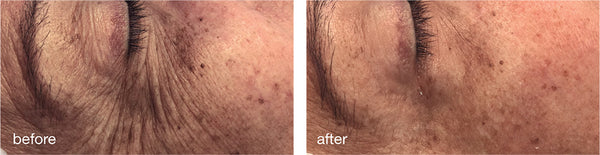 Mesoestetic Global Eyecon Treatment