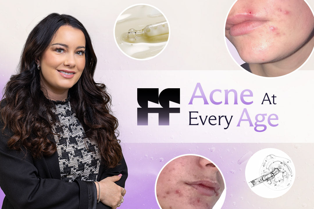acne at every age story