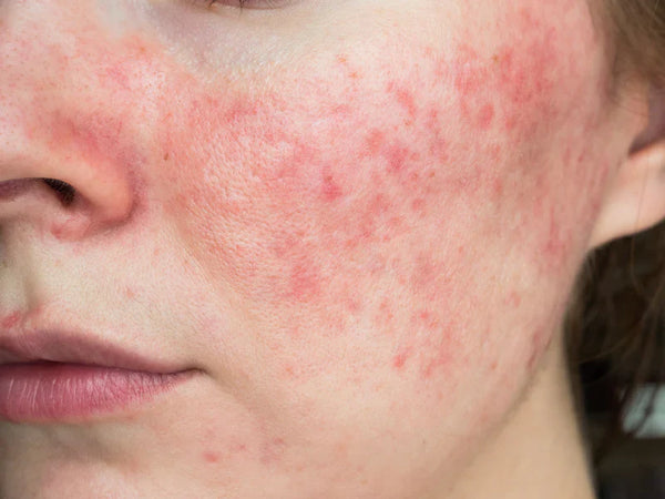 How To Tell The Difference Between Rosacea And Perioral Dermatitis