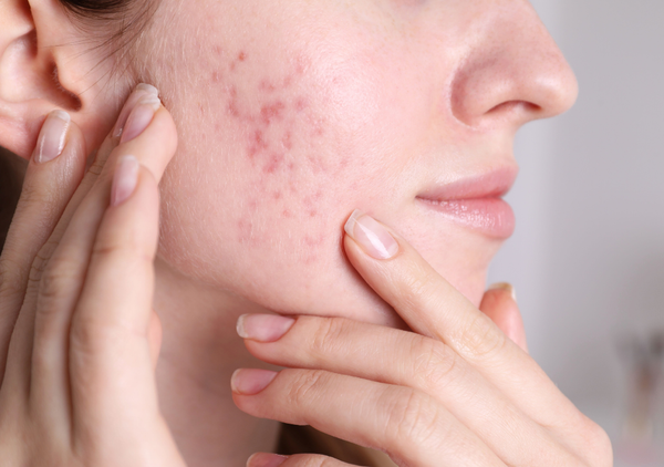 Acne Scar Treatment: What Works for Dark Marks vs Textured Scars