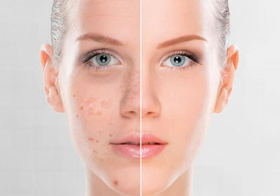 Lady with pigmentation on one side of her face and a clear complexion on the other