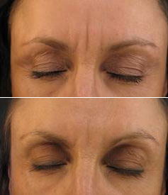 Environ Focus Frown Serum