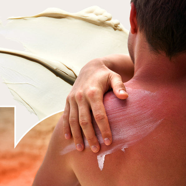 Sunburn Relief