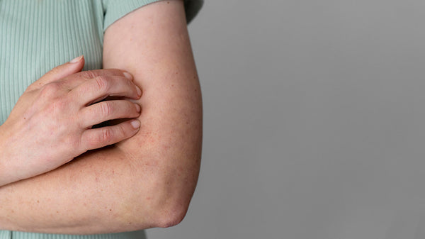 Products for Psoriasis