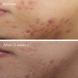 Murad Deep Relief Blemish Treatment