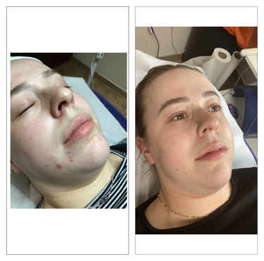 Clients skin treatment before and after