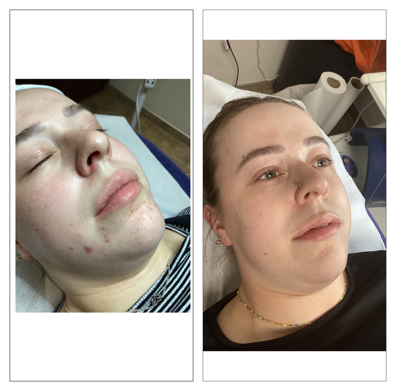 Clients skin treatment before and after