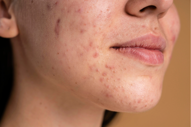 hormonal acne breakouts a simple skincare routine for clearer skin