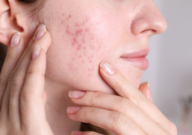 adult acne advice