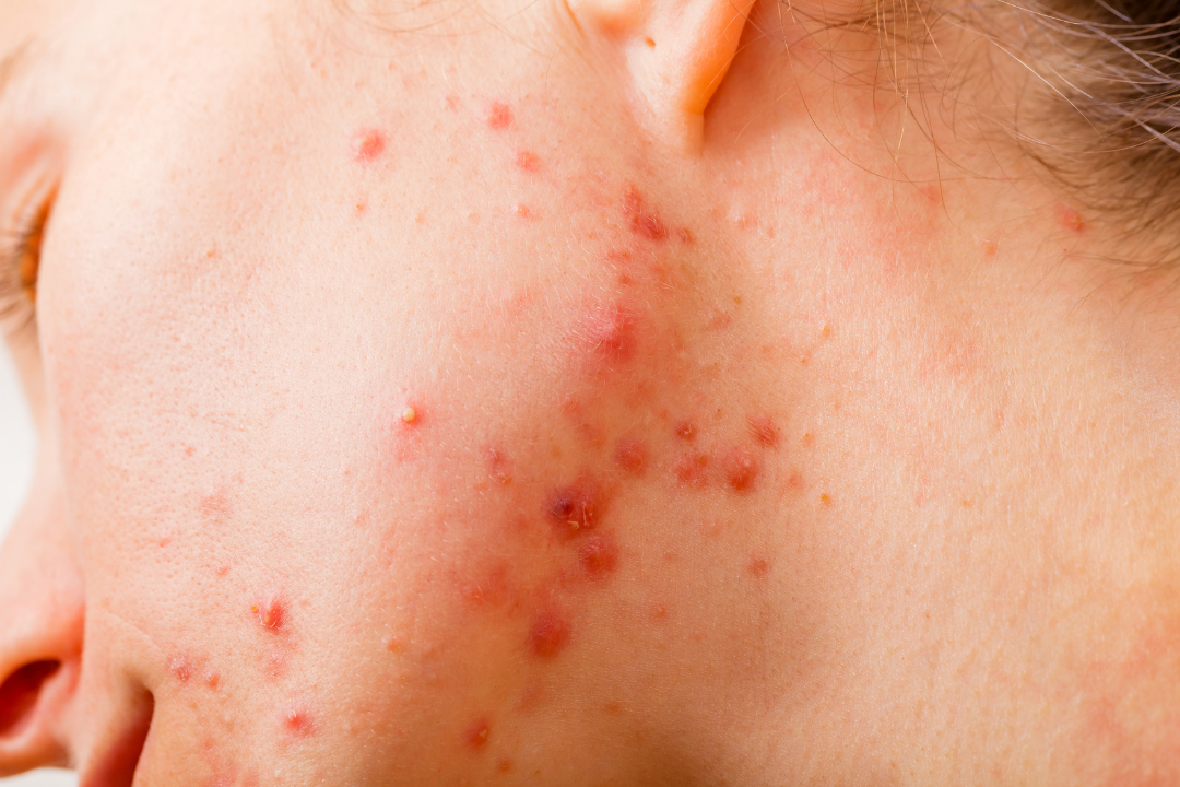 chin and jawline acne