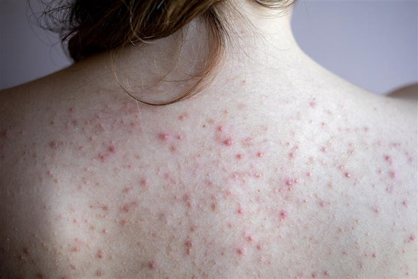 Back Acne Treatments: How To Get Rid Of Bacne