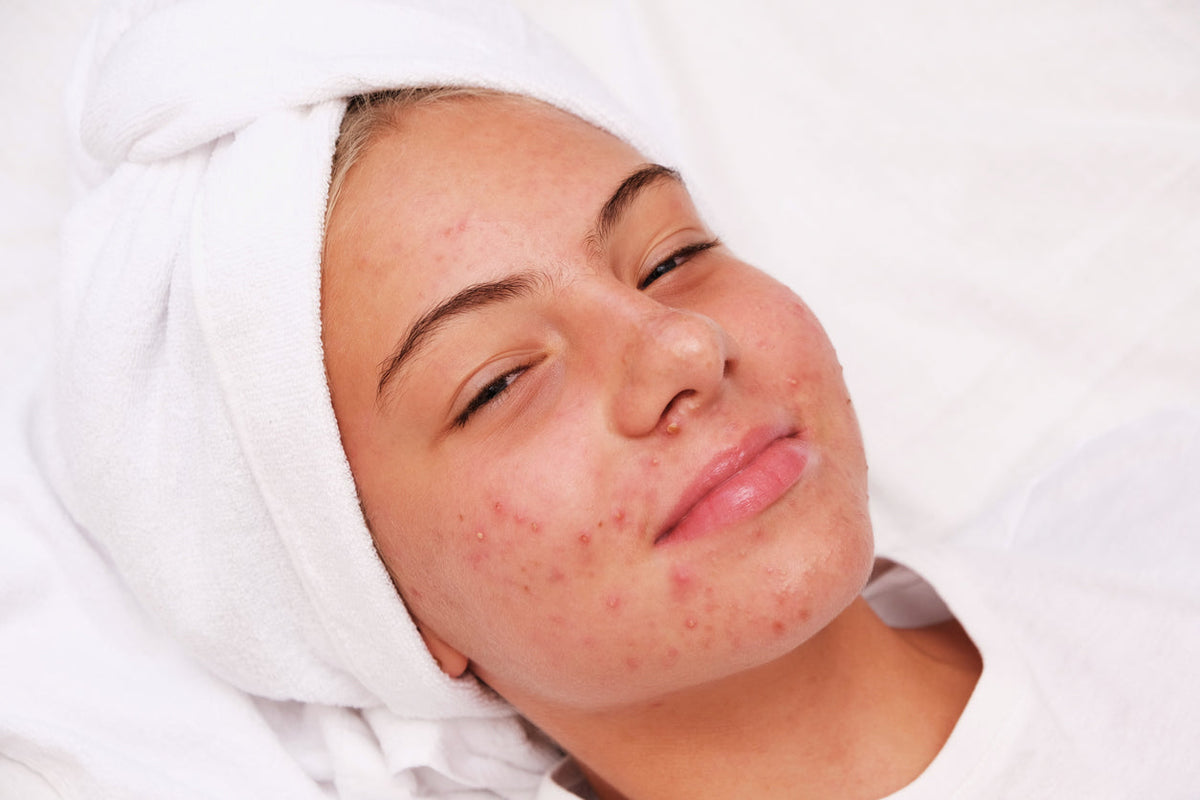 teenage acne