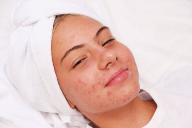 teenage acne