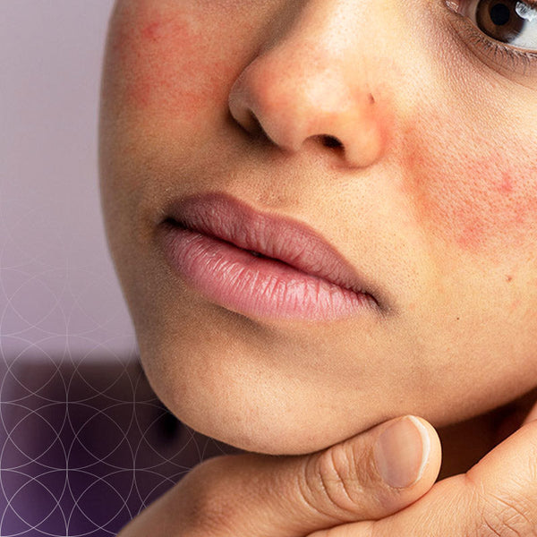 rosacea skincare products