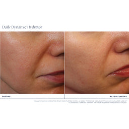 Before-and-after skin comparison showing the cheek and mouth area of a person using Daily Dynamic Hydrator, with visible improvement after 2 weeks.