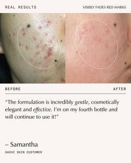 Sachi Skin Triphala Pigmentation Corrector 30ml