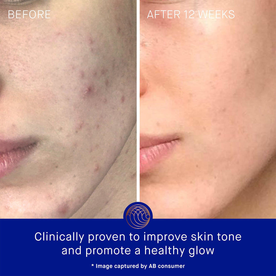 Before and after comparison of skin treatment showing improved skin tone.