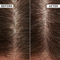 A close-up before-and-after comparison of a hairline and scalp, with the left side labeled BEFORE and the right side labeled AFTER. The before image shows a fuller scalp with visible dandruff flakes and dense dark hair, while the after image shows a smoother scalp with reduced flakes and healthier-looking hair.