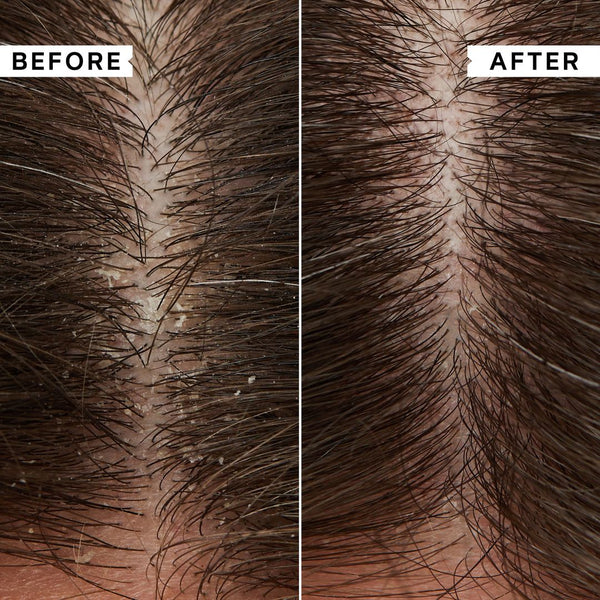 A close-up before-and-after comparison of a hairline and scalp, with the left side labeled BEFORE and the right side labeled AFTER. The before image shows a fuller scalp with visible dandruff flakes and dense dark hair, while the after image shows a smoother scalp with reduced flakes and healthier-looking hair.