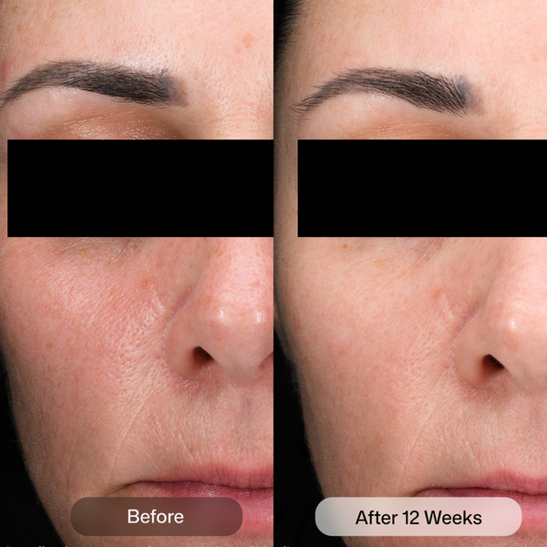 Before-and-after facial skin comparison of a woman's lower face, showing wrinkles and skin texture improvement after 12 weeks. The eyes are obscured with black blocks, and labels at the bottom read 'Before' and 'After 12 Weeks'.