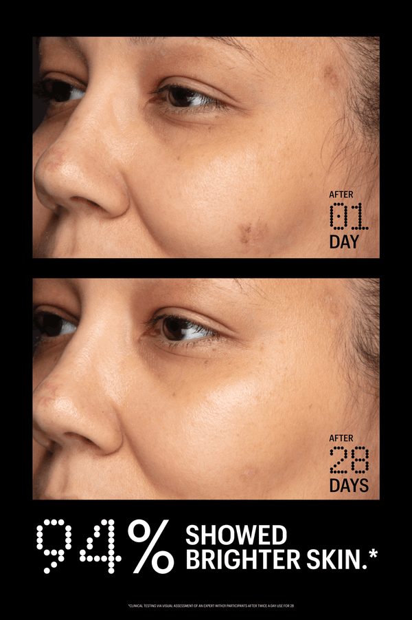 Before and after comparison of skin treatment showing improvement over 28 days.