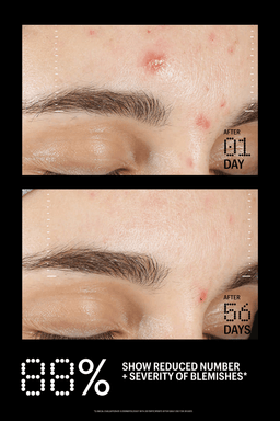Before and after comparison of blemishes on a person's face with text indicating reduction over time.