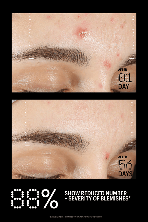 Before and after comparison of blemishes on a person's face with text indicating reduction over time.