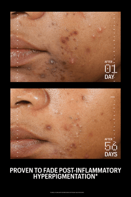 Before and after comparison of post-inflammatory hyperpigmentation on skin, showing visible improvement over 56 days.