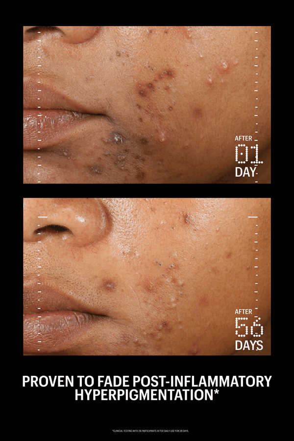 Before and after comparison of post-inflammatory hyperpigmentation on skin, showing visible improvement over 56 days.