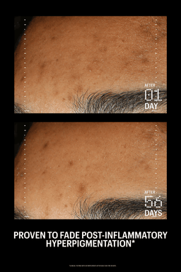 Before and after comparison of post-inflammatory hyperpigmentation on skin.