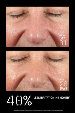Before and after comparison of a person's face with text indicating 40% less irritation in 1 month.