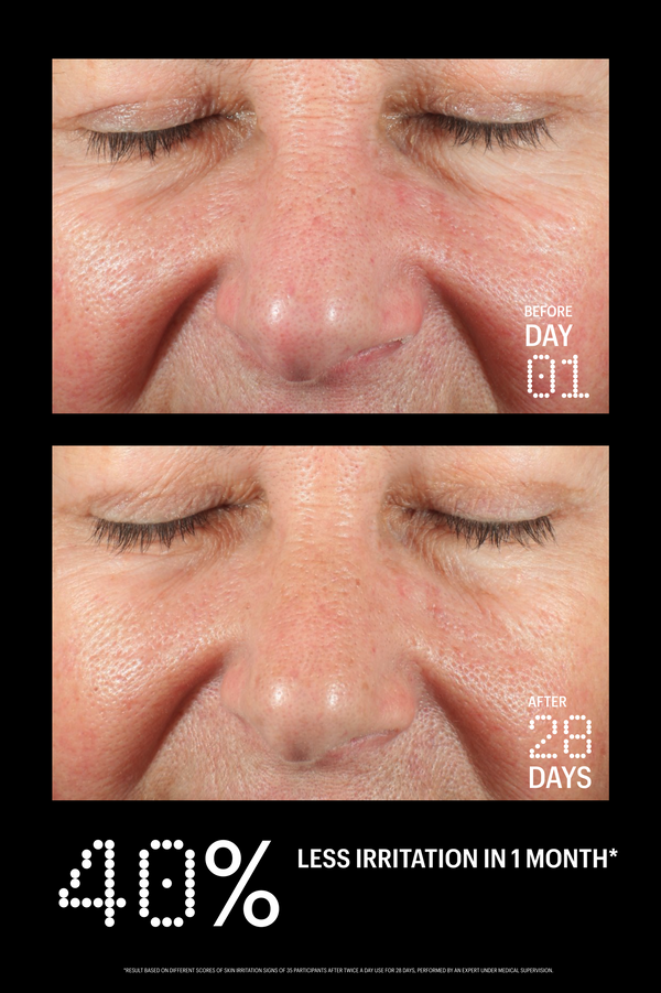 Before and after comparison of a person's face with text indicating 40% less irritation in 1 month.