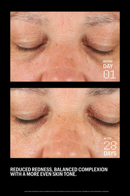 Before-and-after skincare results comparison showing a close-up of a person's closed eyes and cheek area, with text reading 'REDUCED REDNESS, BALANCED COMPLEXION WITH A MORE EVEN SKIN TONE' on a black background.