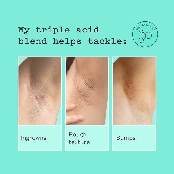 A promotional graphic on a mint green background with text reading 'My triple acid blend helps tackle:' and three inset close-up photos of skin showing ingrown marks, rough texture, and bumps. A small circular logo at top right says 'Acid Acne + AHA'.