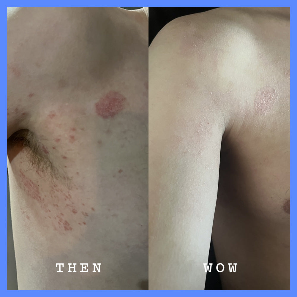 Before and after comparison of skin condition on a person's shoulder.
