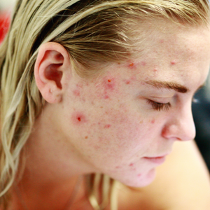 Millennial Acne